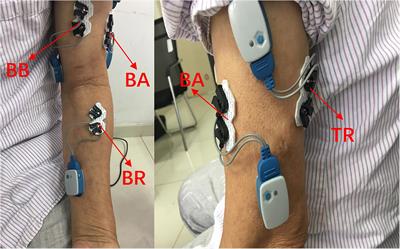 A Novel Quantitative Spasticity Evaluation Method Based on Surface Electromyogram Signals and Adaptive Neuro Fuzzy Inference System
